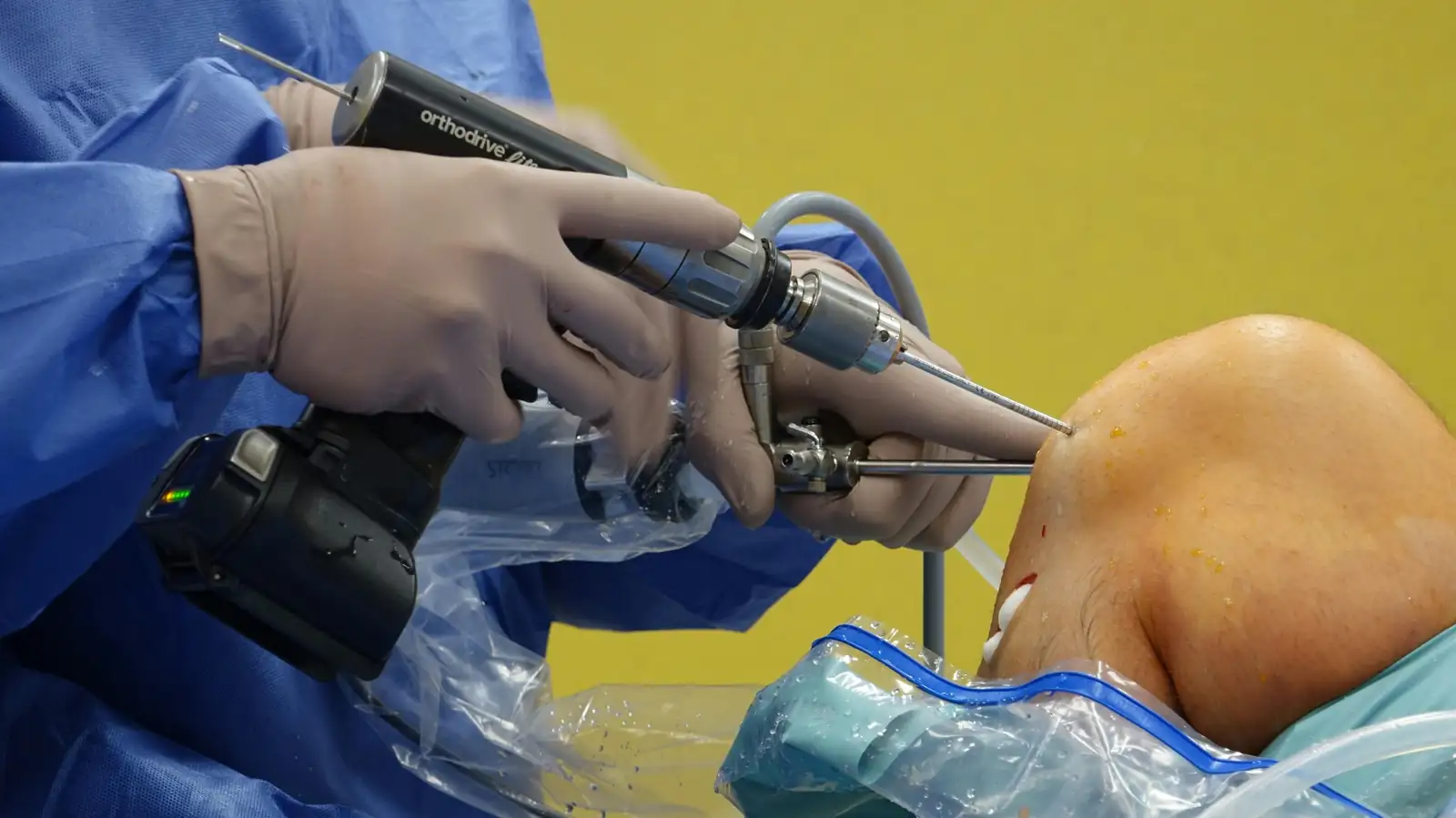 ArthroscopyLigament
