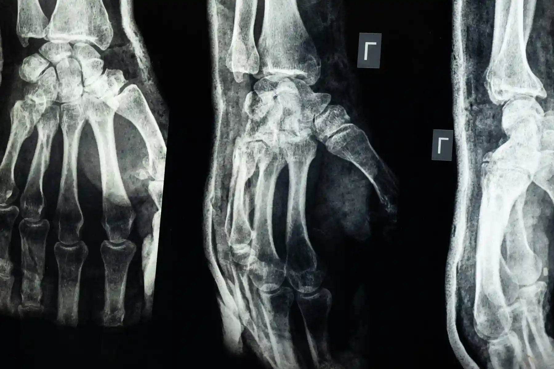 Fracture and Trauma Treatment Lucknow